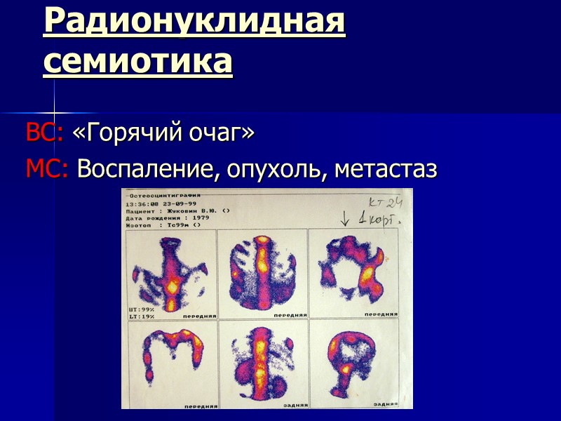Радионуклидная семиотика ВС: «Горячий очаг» МС: Воспаление, опухоль, метастаз